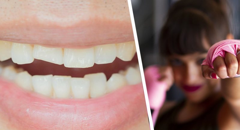 Deporte y traumatismos dentales: qué hacer cuando se rompe un diente
