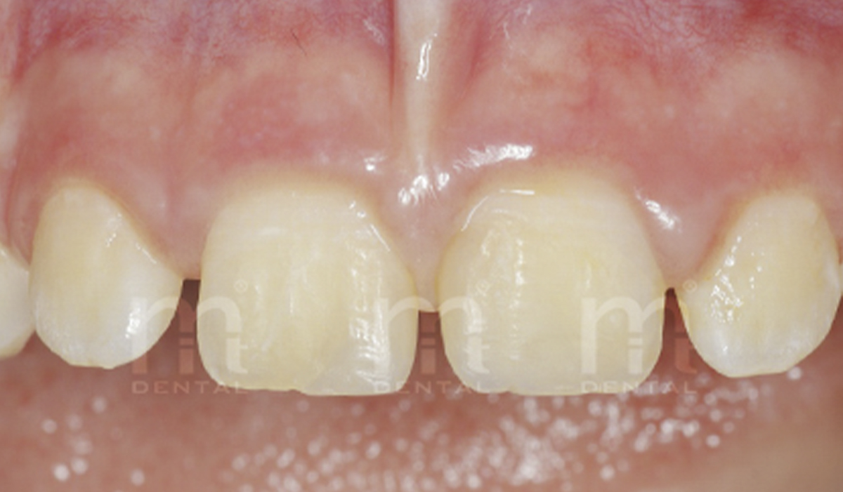Traumatismo dental en niños